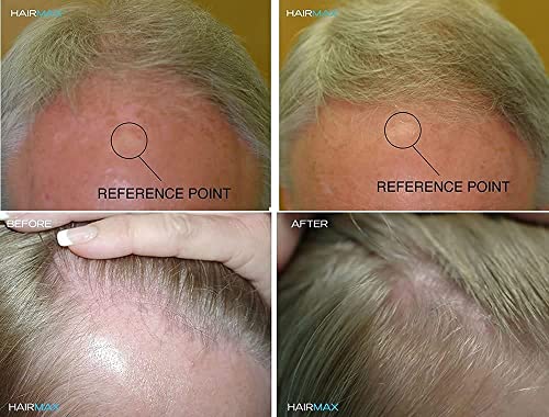 HairMax RegrowMD Laser Hair Growth Cap, FDA Cleared, 272 Medical Grade Lasers, Hair Loss Treatment for Men and Women, Full Scalp Treatment to Reverse Thinning Hair while growing Denser, Fuller Hair